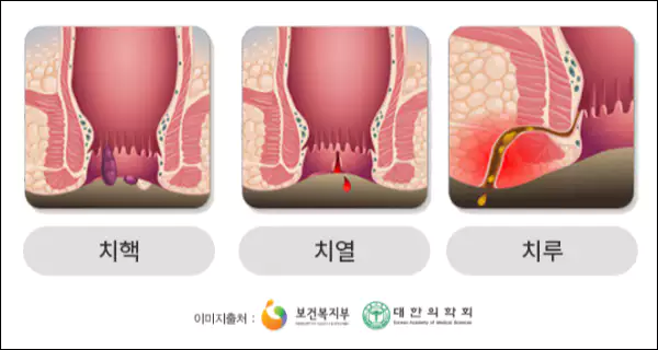 치핵-치열-치루-차이